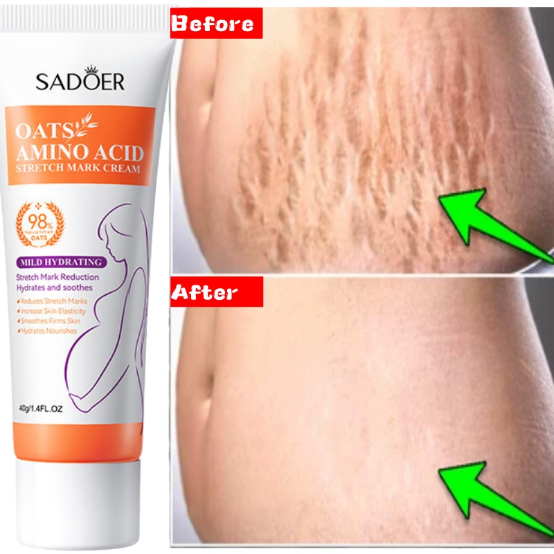 Skincare Oat - Creme de remoção permanente de estrias,